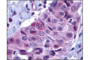 Immunohistochemistry of PUMA in human breast carcinoma with PUMA antibody at 10 μg/ml.