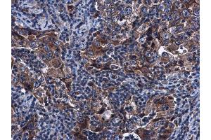 IHC-P Image SIRT3 antibody [C3], C-term detects SIRT3 protein at cytoplasm in human endometrial carcinoma by immunohistochemical analysis.