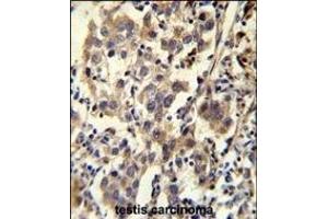CCD Antibody (C-term) (ABIN655703 and ABIN2845154) immunohistochemistry analysis in formalin fixed and paraffin embedded human testis carcinoma followed by peroxidase conjugation of the secondary antibody and DAB staining.