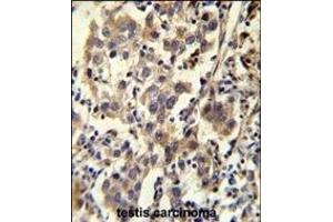 CCD Antibody (C-term) (ABIN655703 and ABIN2845154) immunohistochemistry analysis in formalin fixed and paraffin embedded human testis carcinoma followed by peroxidase conjugation of the secondary antibody and DAB staining. (CCDC110 anticorps  (C-Term))