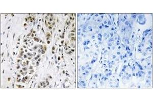 Immunohistochemistry analysis of paraffin-embedded human breast carcinoma tissue, using XRN2 Antibody.