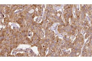 ABIN6267115 at 1/100 staining Human thyroid cancer tissue by IHC-P. (EIF4G1 anticorps  (pSer1147))
