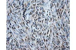 Immunohistochemical staining of paraffin-embedded Adenocarcinoma of ovary tissue using anti-HSPA1Amouse monoclonal antibody. (HSP70 1A anticorps)