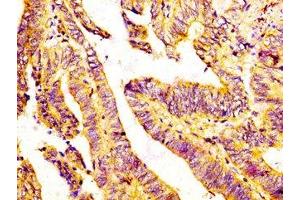 IHC image of ABIN7154550 diluted at 1:300 and staining in paraffin-embedded human colon cancer performed on a Leica BondTM system.