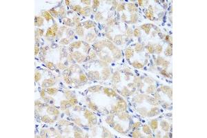 Immunohistochemistry of paraffin-embedded human stomach cancer using ANKRD52 antibody. (ANKRD52 anticorps  (AA 450-660))
