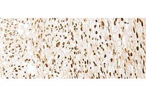 Immunohistochemistry of paraffin-embedded Human liver cancer tissue using PRPF3 Polyclonal Antibody at dilution of 1:35(x200) (PRPF3 anticorps)