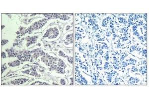 Immunohistochemical analysis of paraffin-embedded human breast carcinoma tissue using AKT1/AKT2/AKT3(Phospho-Tyr315/316/312) Antibody(left) or the same antibody preincubated with blocking peptide(right). (AKT1 anticorps  (pTyr312, pTyr315, pTyr316))