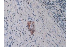 Detection of Hepc in Human Pancreatic cancer Tissue using Monoclonal Antibody to Hepcidin (Hepc) (Hepcidin anticorps  (AA 25-84))