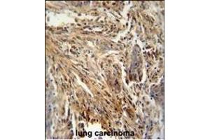 CSF2 antibody (Center) (ABIN654647 and ABIN2844343) immunohistochemistry analysis in formalin fixed and paraffin embedded human lung carcinoma followed by peroxidase conjugation of the secondary antibody and DAB staining. (GM-CSF anticorps  (AA 59-85))
