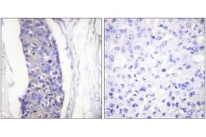 Immunohistochemistry analysis of paraffin-embedded human breast carcinoma tissue, using Tubulin alpha Antibody. (alpha Tubulin anticorps)