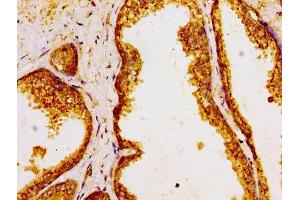 Immunohistochemistry of paraffin-embedded human prostate cancer using ABIN7154296 at dilution of 1:100