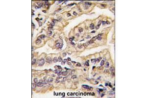 Formalin-fixed and paraffin-embedded human lung carcinoma tissue reacted with CSF1R polyclonal antibody  , which was peroxidase-conjugated to the secondary antibody, followed by DAB staining. (CSF1R anticorps  (C-Term))