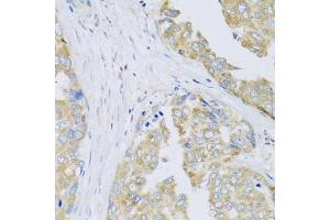 Immunohistochemistry of paraffin-embedded human liver cancer using ARFGAP3 antibody (ABIN5974520) at dilution of 1/100 (40x lens). (ARFGAP3 anticorps)