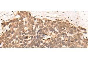 Immunohistochemistry of paraffin-embedded Human thyroid cancer tissue using CLK2 Polyclonal Antibody at dilution of 1:45(x200) (CLK2 anticorps)