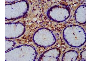 IHC image of ABIN7166315 diluted at 1:200 and staining in paraffin-embedded human gastric cancer performed on a Leica BondTM system.