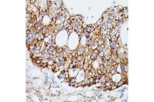 Immunohistochemistry of paraffin-embedded human colon carcinoma using MK4 antibody (ABIN7268654) at dilution of 1:100 (40x lens). (MAP3K4 anticorps  (AA 1-100))