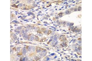 Immunohistochemistry of paraffin-embedded Human gastric cancer using GCLM Polyclonal Antibody at dilution of 1:100 (40x lens). (GCLM anticorps)