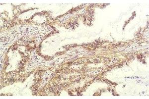 Immunohistochemistry of paraffin-embedded Human lung carcinoma tissue using IL8 Monoclonal Antibody at dilution of 1:200. (IL-8 anticorps)