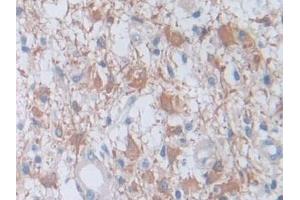 Detection of F8 in Human Glioma Tissue using Polyclonal Antibody to Coagulation Factor VIII (F8)