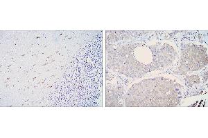 Immunohistochemical analysis of paraffin-embedded cerebellum tissues (left) and lung cancer (right) using ALDH1A1 mouse mAb with DAB staining.