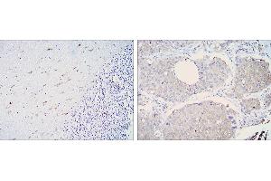 Immunohistochemical analysis of paraffin-embedded cerebellum tissues (left) and lung cancer (right) using ALDH1A1 mouse mAb with DAB staining. (ALDH1A1 anticorps)