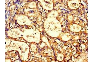 Immunohistochemistry of paraffin-embedded human gastric cancer using ABIN7171428 at dilution of 1:100