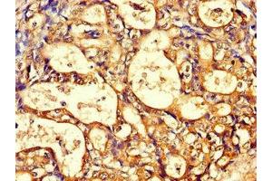 Immunohistochemistry of paraffin-embedded human gastric cancer using ABIN7171428 at dilution of 1:100 (CCT8 anticorps  (AA 224-491))
