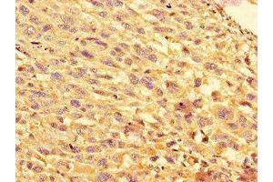 Immunohistochemistry of paraffin-embedded human melanoma using ABIN7152193 at dilution of 1:100 (eIF4EBP1 anticorps  (AA 2-111))