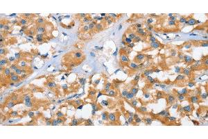 Immunohistochemistry of paraffin-embedded Human thyroid cancer tissue using CXCL14 Polyclonal Antibody at dilution 1:40 (CXCL14 anticorps)