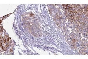 ABIN6277846 at 1/100 staining Human urothelial cancer tissue by IHC-P. (INSRR anticorps  (N-Term))