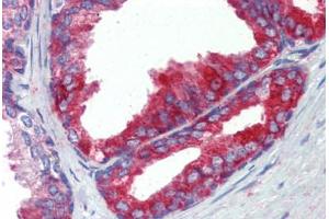 Human Prostate (formalin-fixed, paraffin-embedded) stained with FASN antibody ABIN462322 followed by biotinylated goat anti-rabbit IgG secondary antibody ABIN481713, alkaline phosphatase-streptavidin and chromogen. (Fatty Acid Synthase anticorps  (AA 942-973))