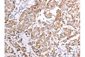 The image on the left is immunohistochemistry of paraffin-embedded Human breast cancer tissue using ABIN7128594(ATPIF1 Antibody) at dilution 1/50, on the right is treated with fusion protein.