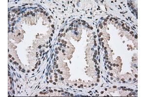 Immunohistochemical staining of paraffin-embedded Adenocarcinoma of Human ovary tissue using anti-BAT1 mouse monoclonal antibody. (BAT1 anticorps)