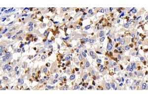 Detection of Bcl2L in Human Liver cancer Tissue using Monoclonal Antibody to B-Cell CLL/Lymphoma 2 Like Protein (Bcl2L)