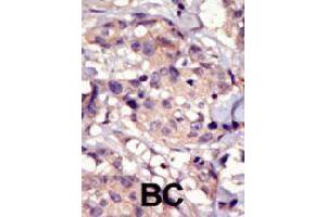 Formalin-fixed and paraffin-embedded human cancer tissue reacted with PDGFRA polyclonal antibody  , which was peroxidase-conjugated to the secondary antibody, followed by DAB staining. (PDGFRA anticorps  (C-Term))