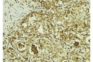 ABIN6267214 at 1/100 staining Human breast cancer tissue by IHC-P. (CDK6 anticorps  (pTyr292))