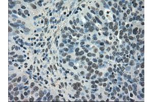 Immunohistochemical staining of paraffin-embedded Carcinoma of kidney tissue using anti-NEK6mouse monoclonal antibody. (NEK6 anticorps)