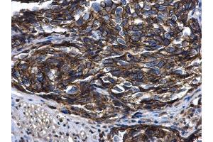 IHC-P Image ARFIP2 antibody [N1C2] detects ARFIP2 protein at cytoplasm in human cervical cancer by immunohistochemical analysis.