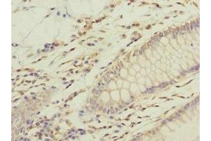 Immunohistochemistry of paraffin-embedded human colon cancer using ABIN7168218 at dilution of 1:100 (GFM2 anticorps  (AA 520-779))