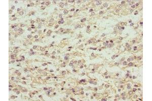 Immunohistochemistry of paraffin-embedded human glioma using ABIN7159294 at dilution of 1:100 (MAGED1 anticorps  (AA 579-778))