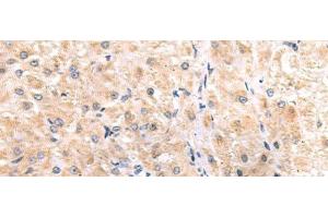 Immunohistochemistry of paraffin-embedded Human liver cancer tissue using ITGA3 Polyclonal Antibody at dilution of 1:45(x200) (ITGA3 anticorps)