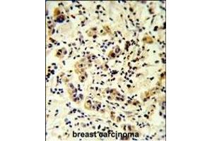 CC50B Antibody (N-term) (ABIN651159 and ABIN2840104) IHC analysis in formalin fixed and paraffin embedded human breast carcinoma followed by peroxidase conjugation of the secondary antibody and DAB staining. (TMEM30B anticorps  (N-Term))