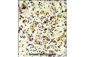 CC50B Antibody (N-term) (ABIN651159 and ABIN2840104) IHC analysis in formalin fixed and paraffin embedded human breast carcinoma followed by peroxidase conjugation of the secondary antibody and DAB staining.