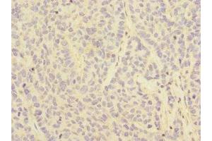 Immunohistochemistry of paraffin-embedded human ovarian cancer using ABIN7158546 at dilution of 1:100 (FCGR2C anticorps  (AA 43-223))