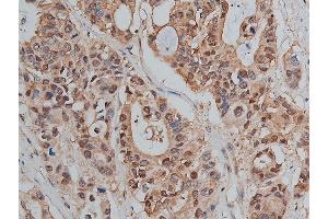 ABIN6255221 and ABIN6267478 at 1/50 staining human colon cancer tissue sections by IHC-P.
