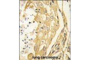 Formalin-fixed and paraffin-embedded human lung carcinoma tissue reacted with the EphB4 antibody (ABIN391924 and ABIN2841734) , which was peroxidase-conjugated to the secondary antibody, followed by DAB staining. (EPH Receptor B4 anticorps)