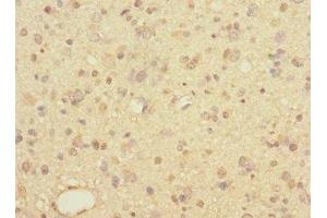 Immunohistochemistry of paraffin-embedded human glioma using ABIN7158053 at dilution of 1:100 (LINGO1 anticorps  (AA 42-240))