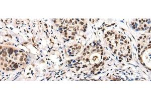 Immunohistochemistry of paraffin-embedded Human cervical cancer tissue using USP6NL Polyclonal Antibody at dilution of 1:30(x200) (USP6NL anticorps)