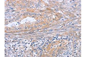 The image on the left is immunohistochemistry of paraffin-embedded Human cervical cancer tissue using ABIN7189998(BOD1 Antibody) at dilution 1/30, on the right is treated with synthetic peptide. (BOD1 anticorps)