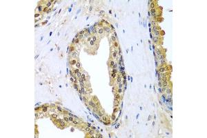 Immunohistochemistry of paraffin-embedded human prostate using TNFSF10 antibody (ABIN3023014, ABIN3023015, ABIN3023016 and ABIN6219347) at dilution of 1:200 (40x lens).